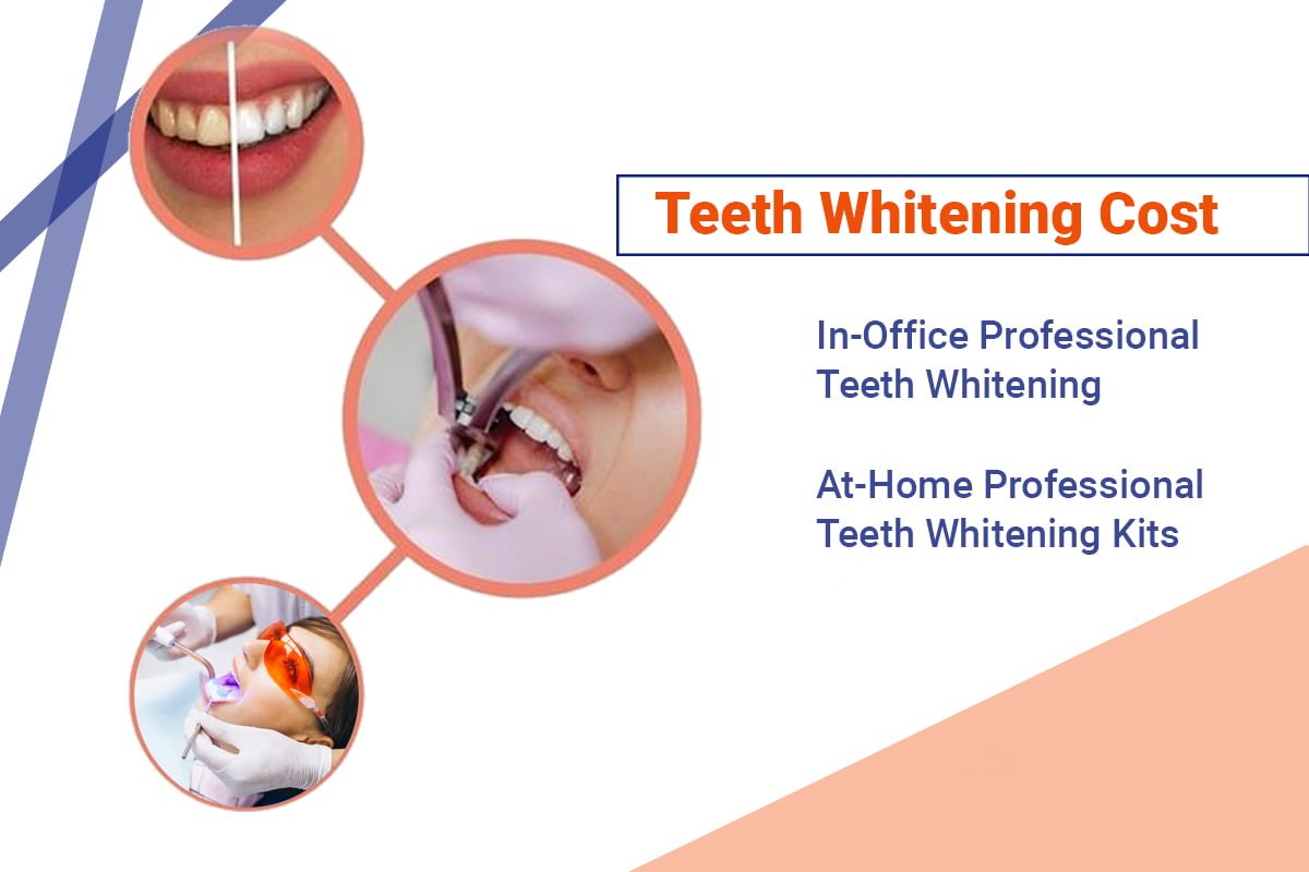 Professional Teeth Whitening in Kolkata Types,Cost,Methods