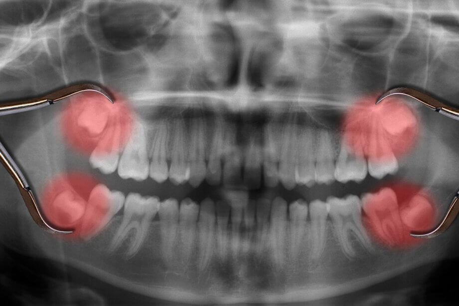 wisdom teeth