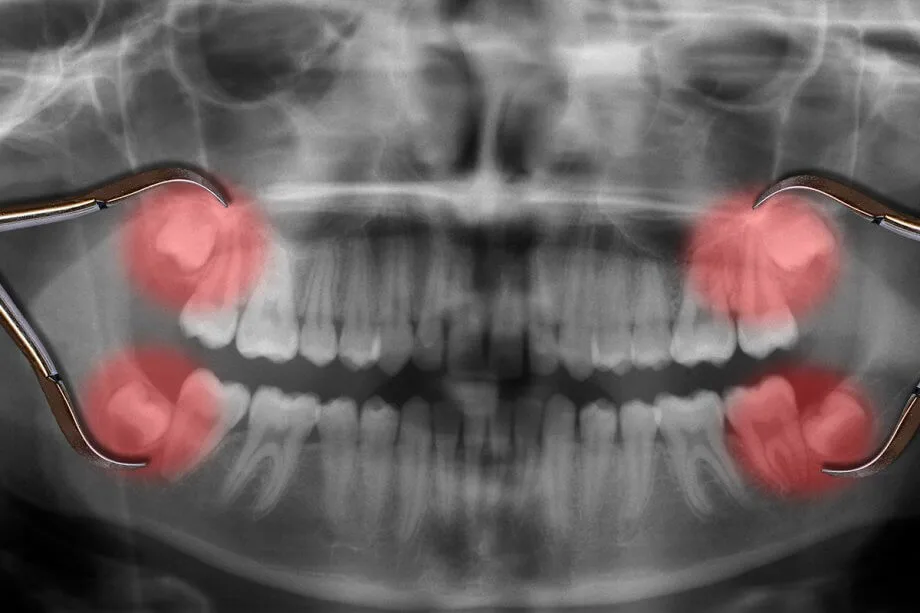 wisdom teeth