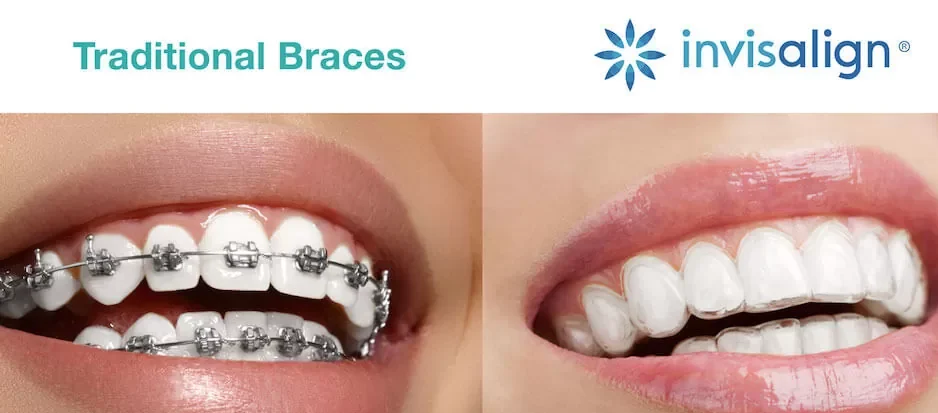 Braces vs. Invisalign: Which One is Best for You in Kolkata?