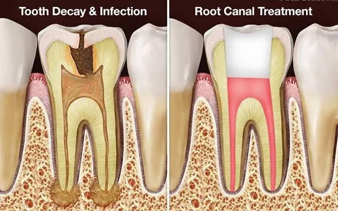 Painless root canal treatment