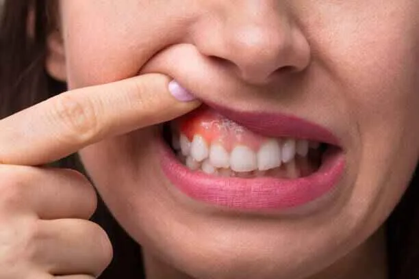 Inflamed gums showing signs of gum disease – best gum treatment in Kolkata at Apollo Dental