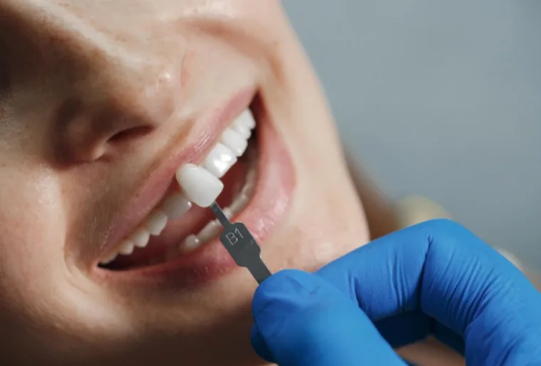 Dental Strip Crowns 