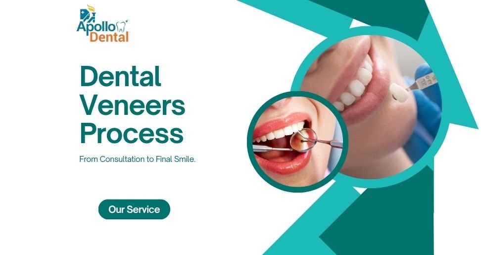 Dental Veneers Process: From Consultation to Final Smile