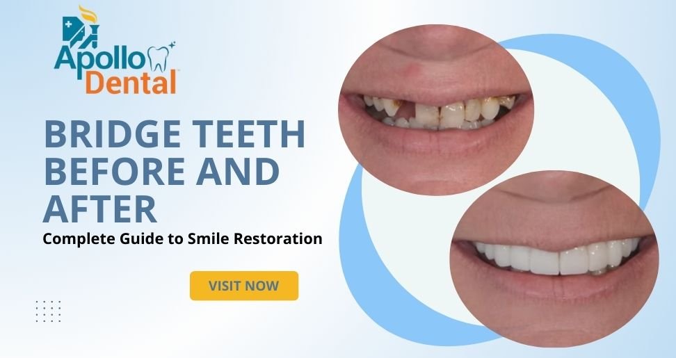 Bridge Teeth Before and After – Complete Guide to Smile Restoration | Apollo Dental