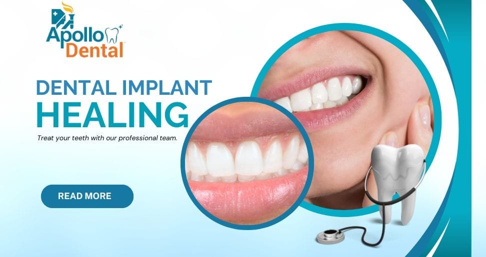 Dental Implant Healing Stages Timeline From Surgery to Final CrownDental Implant Healing Stages Timeline From Surgery to Final Crown