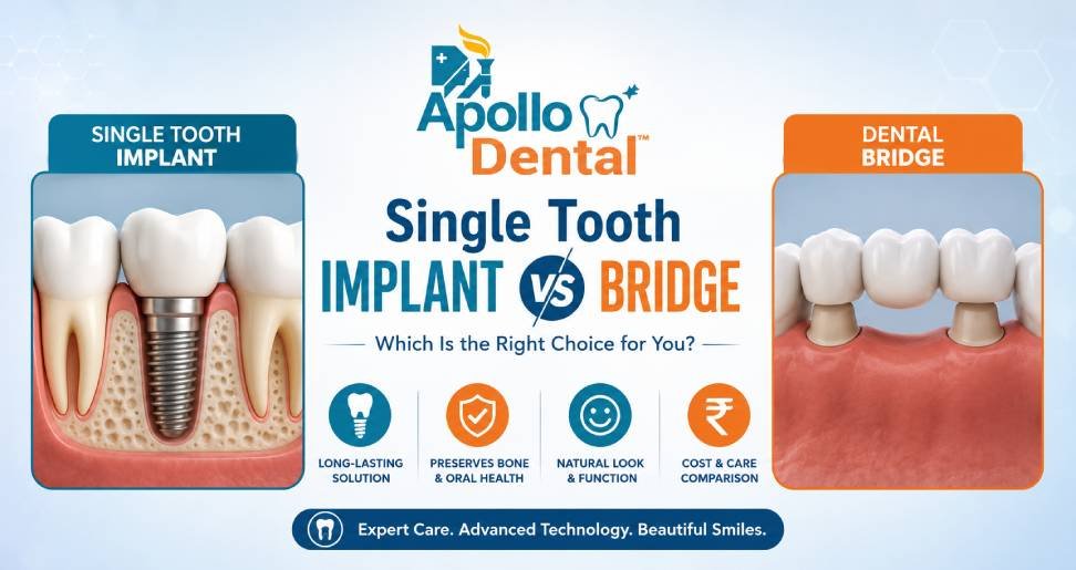 Single Tooth Implant vs Bridge